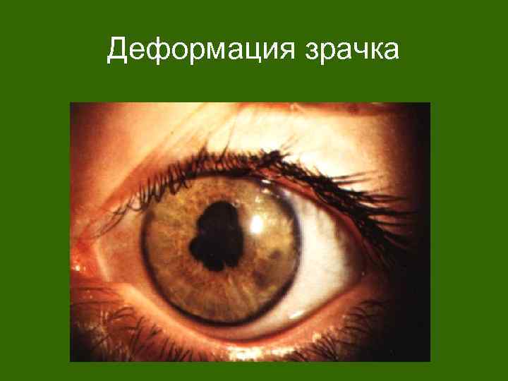Деформация зрачка 