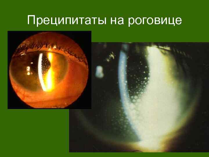 Преципитаты на роговице 