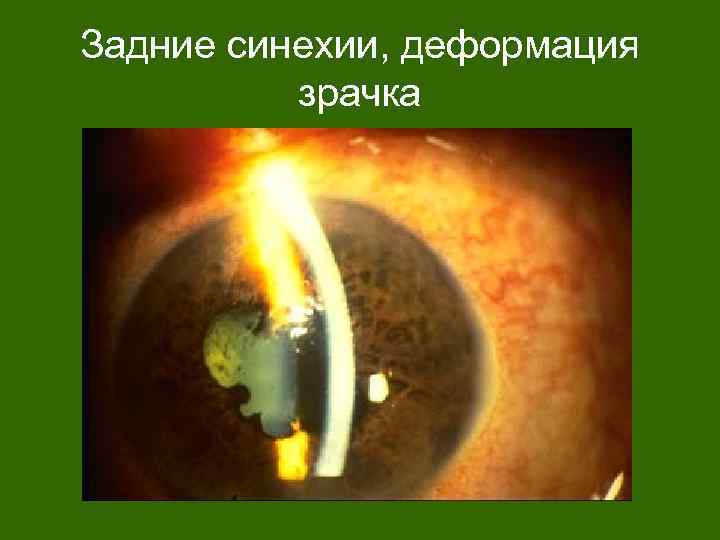 Задние синехии, деформация зрачка 