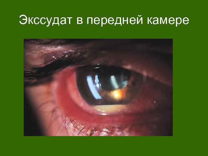 Экссудат в передней камере 
