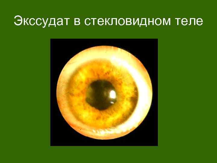 Экссудат в стекловидном теле 