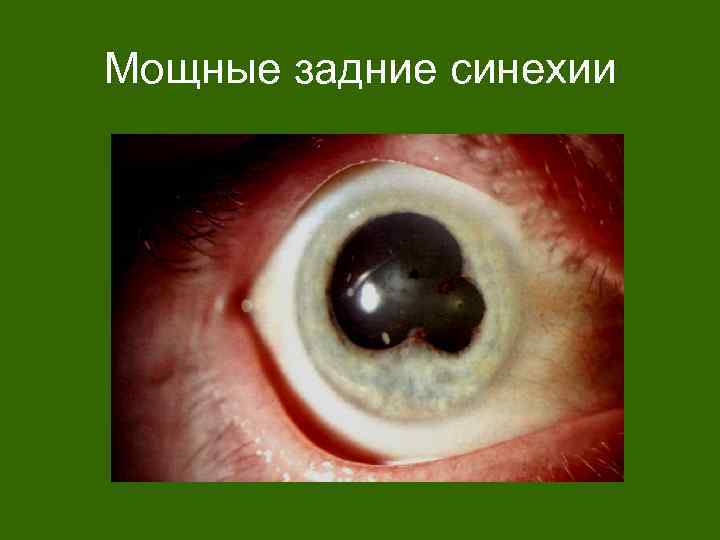 Мощные задние синехии 