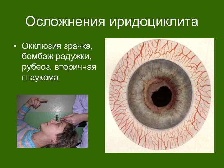 Осложнения иридоциклита • Окклюзия зрачка, бомбаж радужки, рубеоз, вторичная глаукома 