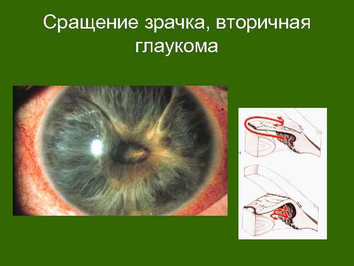 Сращение зрачка, вторичная глаукома 