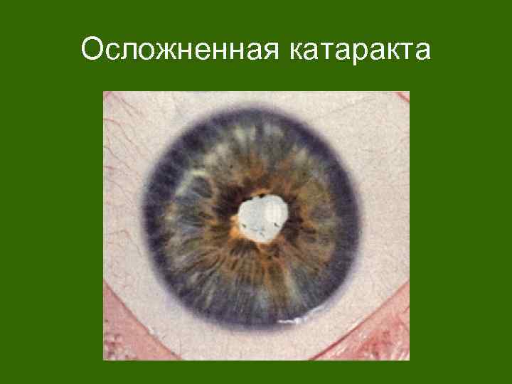 Осложненная катаракта 