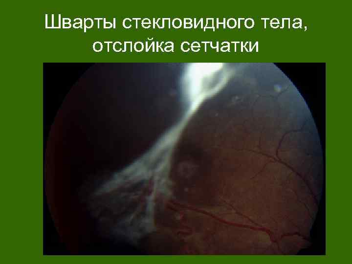 Шварты стекловидного тела, отслойка сетчатки 