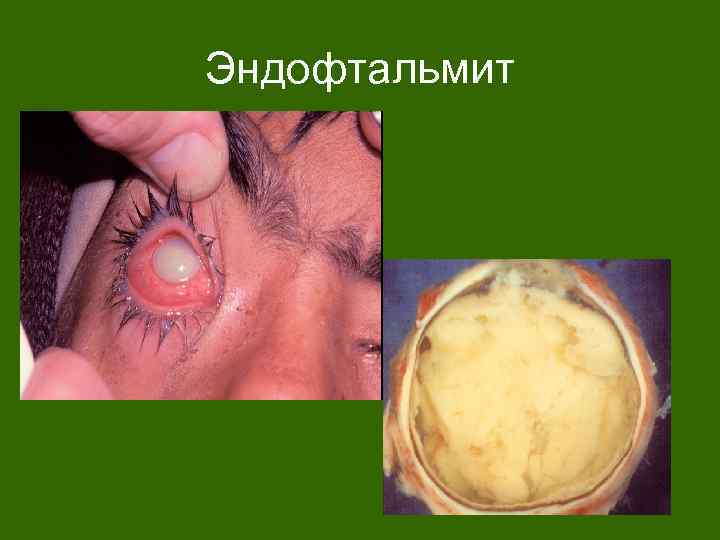 Эндофтальмит 