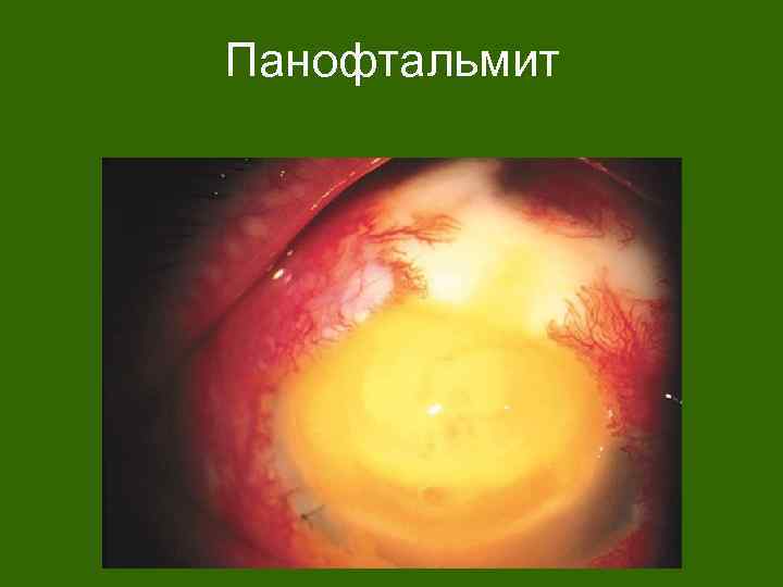 Панофтальмит 