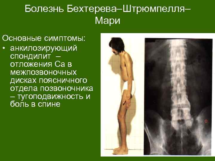 Болезнь Бехтерева–Штрюмпелля– Мари Основные симптомы: • анкилозирующий спондилит – отложения Са в межпозвоночных дисках