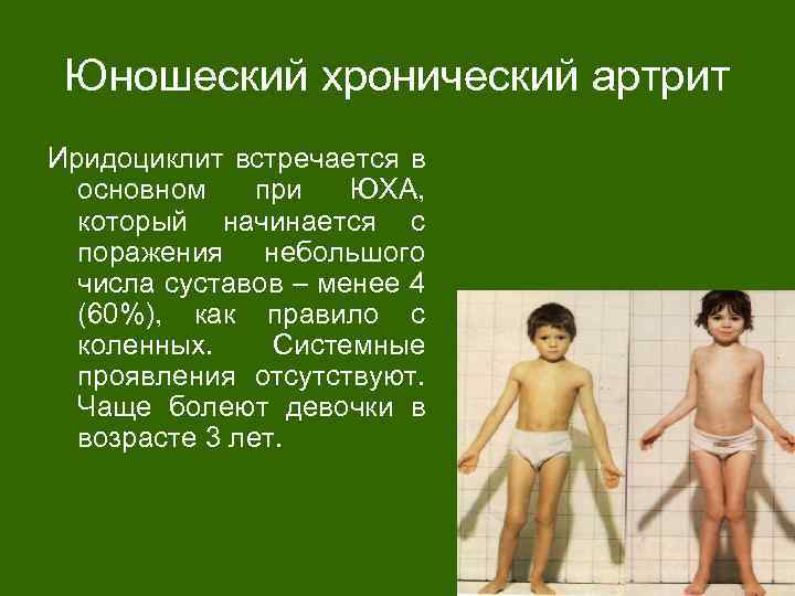 Юношеский хронический артрит Иридоциклит встречается в основном при ЮХА, который начинается с поражения небольшого