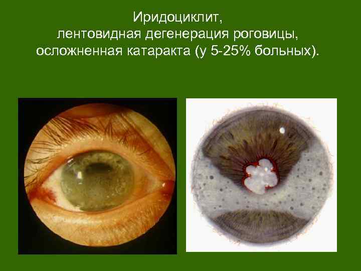 Иридоциклит, лентовидная дегенерация роговицы, осложненная катаракта (у 5 -25% больных). 