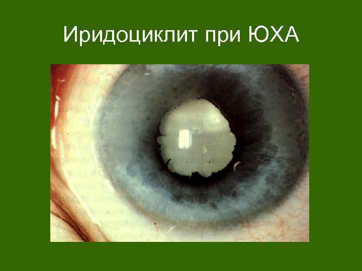 Иридоциклит при ЮХА 