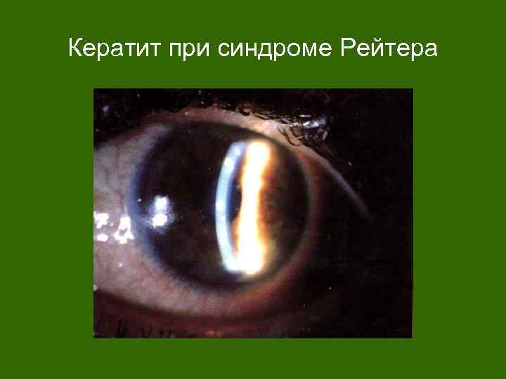 Кератит при синдроме Рейтера 