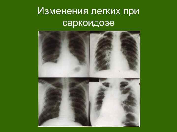 Изменения легких при саркоидозе 