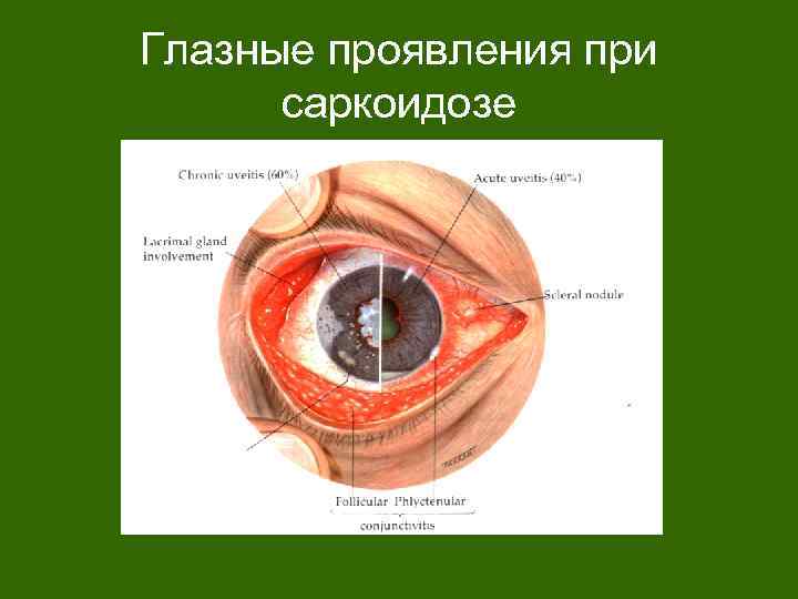Глазные проявления при саркоидозе 