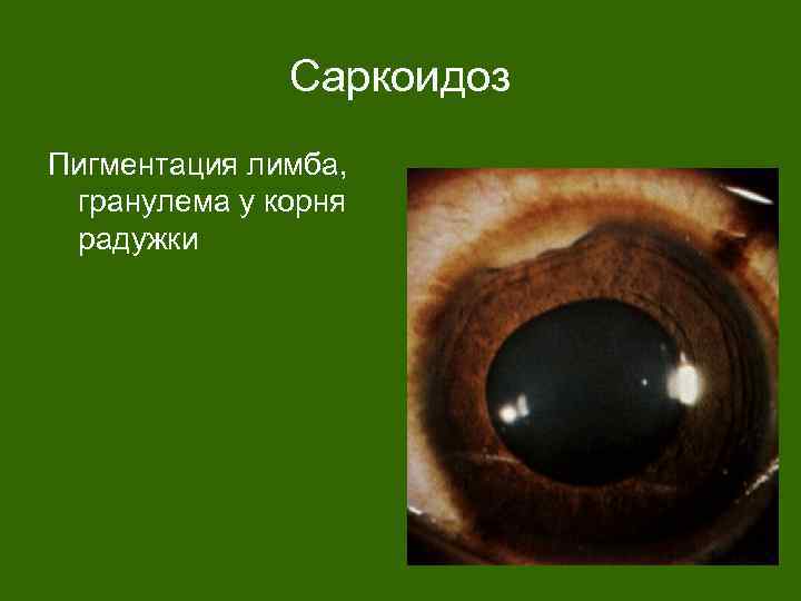 Саркоидоз Пигментация лимба, гранулема у корня радужки 