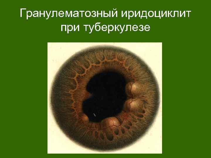 Гранулематозный иридоциклит при туберкулезе 
