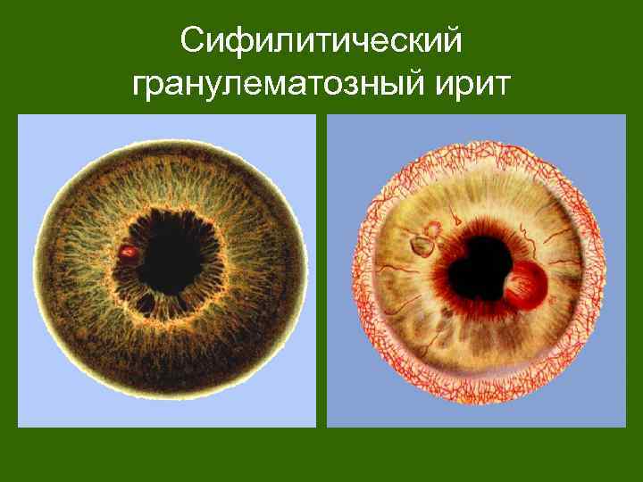 Сифилитический гранулематозный ирит 