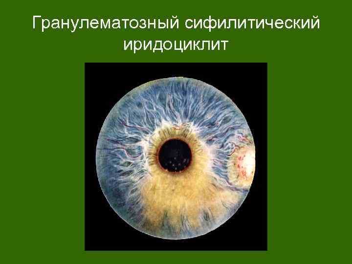 Гранулематозный сифилитический иридоциклит 