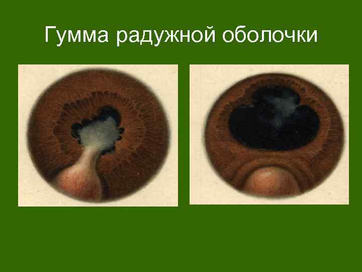 Гумма радужной оболочки 