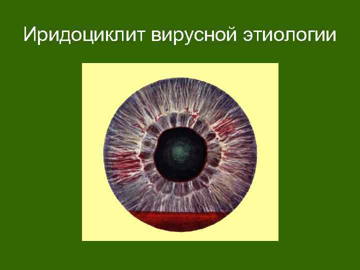 Иридоциклит вирусной этиологии 