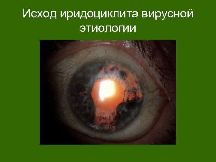 Исход иридоциклита вирусной этиологии 