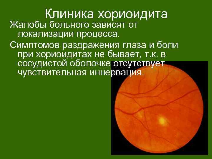 Клиника хориоидита Жалобы больного зависят от локализации процесса. Симптомов раздражения глаза и боли при