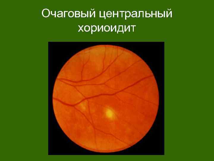 Очаговый центральный хориоидит 