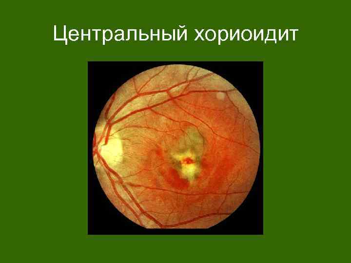 Центральный хориоидит 