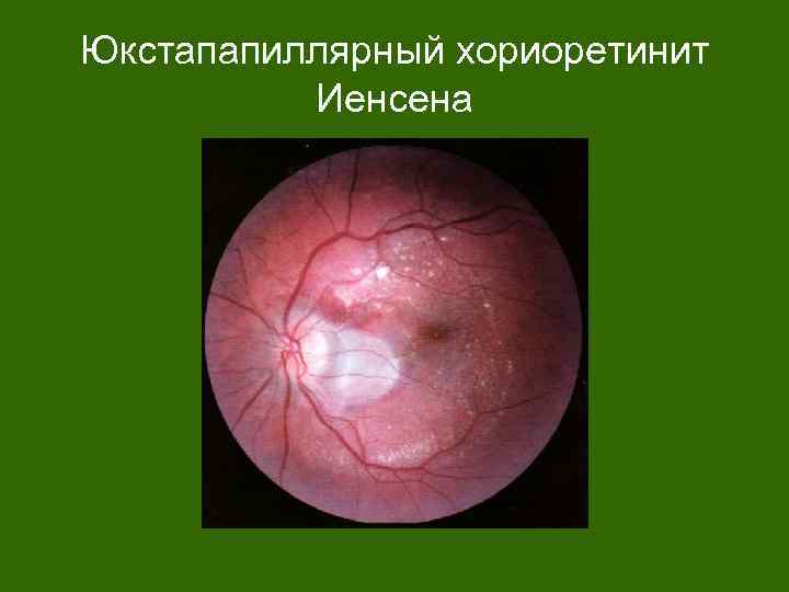 Юкстапапиллярный хориоретинит Иенсена 