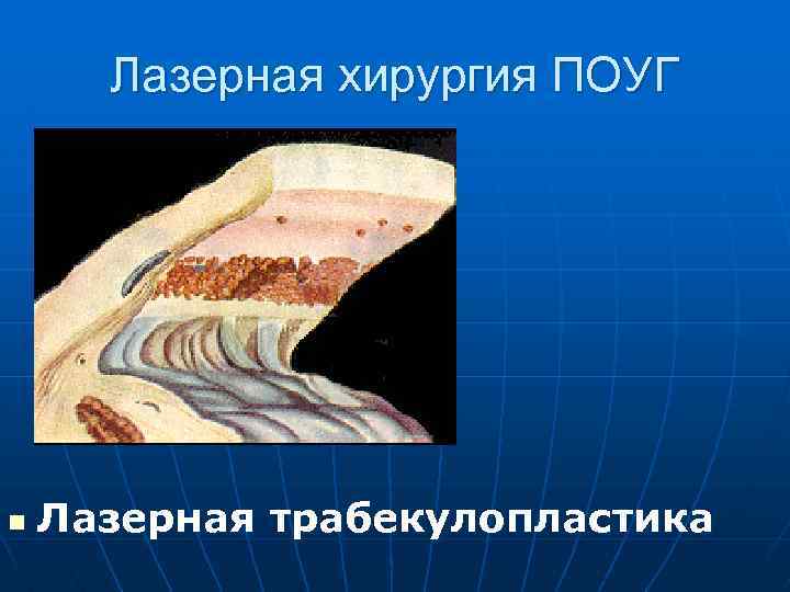 Лазерная хирургия ПОУГ n Лазерная трабекулопластика 