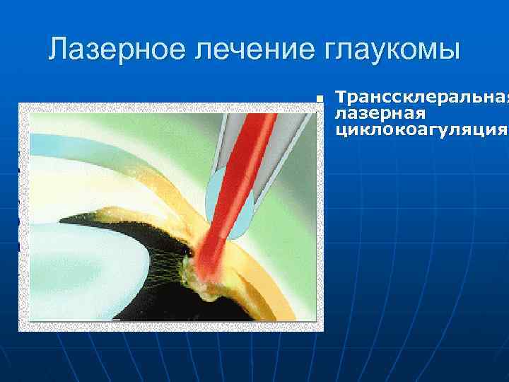 Лазерное лечение глаукомы n Транссклеральная лазерная циклокоагуляция 