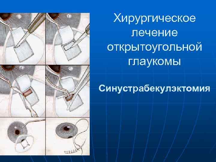 Хирургическое лечение открытоугольной глаукомы Синустрабекулэктомия 