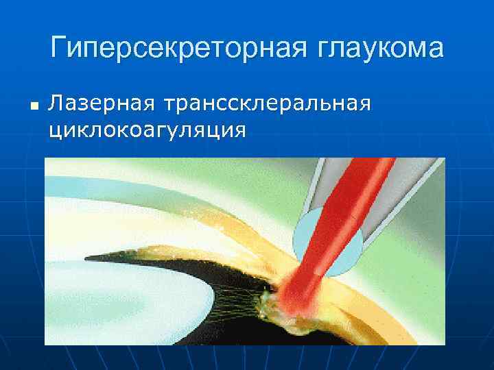 Гиперсекреторная глаукома n Лазерная транссклеральная циклокоагуляция 