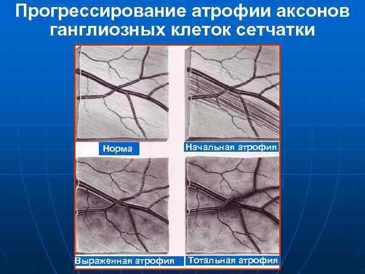 Прогрессирование атрофии аксонов ганглиозных клеток сетчатки Норма Выраженная атрофия Начальная атрофия Тотальная атрофия 