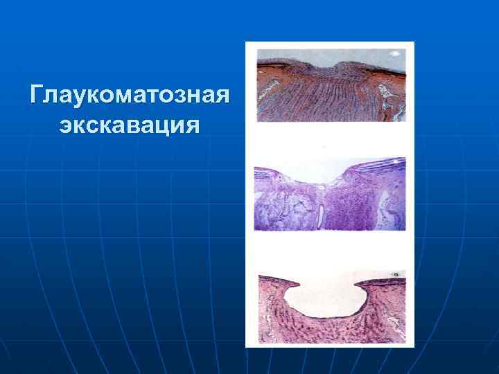 Глаукоматозная экскавация 