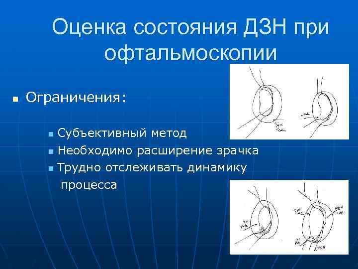 Оценка состояния ДЗН при офтальмоскопии n Ограничения: Субъективный метод n Необходимо расширение зрачка n