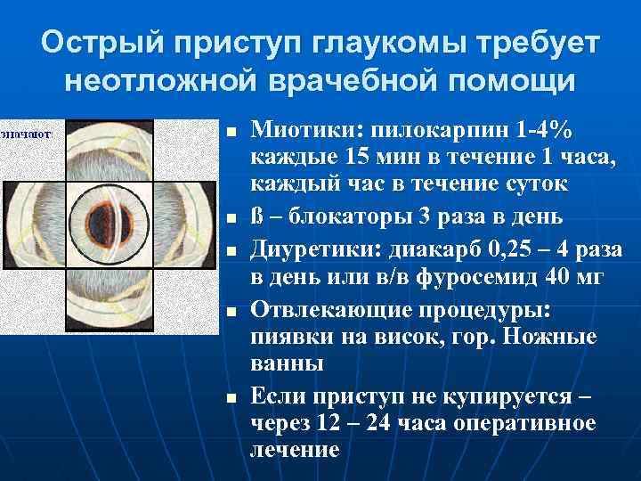 Острый приступ глаукомы требует неотложной врачебной помощи n n n Миотики: пилокарпин 1 -4%