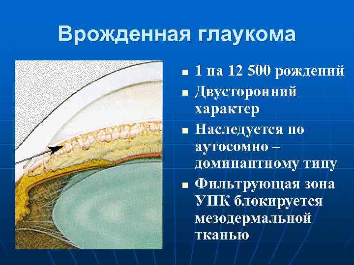 Врожденная глаукома n n 1 на 12 500 рождений Двусторонний характер Наследуется по аутосомно