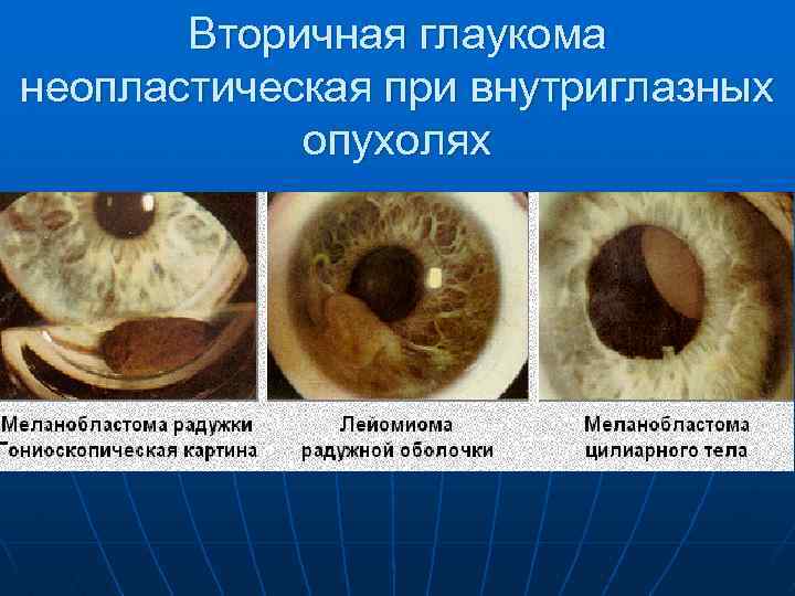 Вторичная глаукома неопластическая при внутриглазных опухолях 