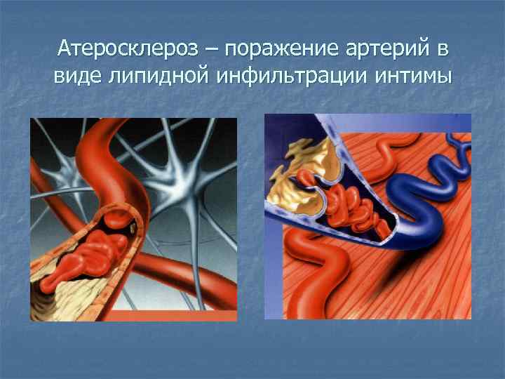 Атеросклероз – поражение артерий в виде липидной инфильтрации интимы 