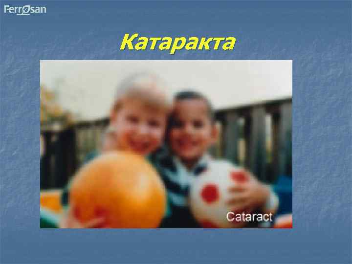 Катаракта 