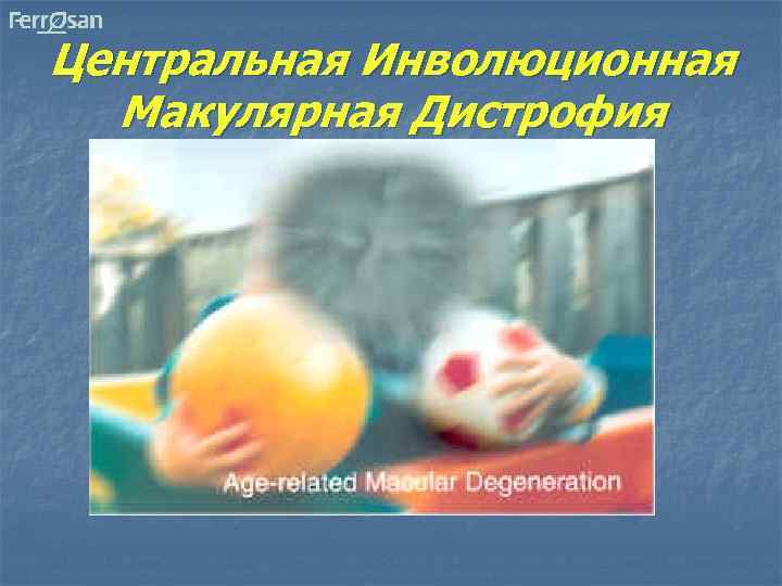 Центральная Инволюционная Макулярная Дистрофия 