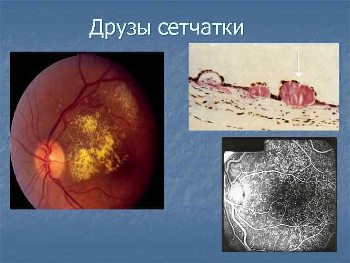 Друзы сетчатки 