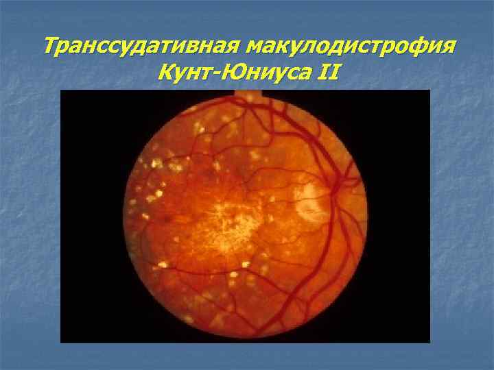 Транссудативная макулодистрофия Кунт-Юниуса II 