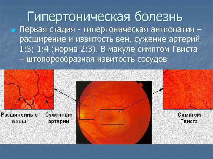 Гипертоническая ангиопатия презентация