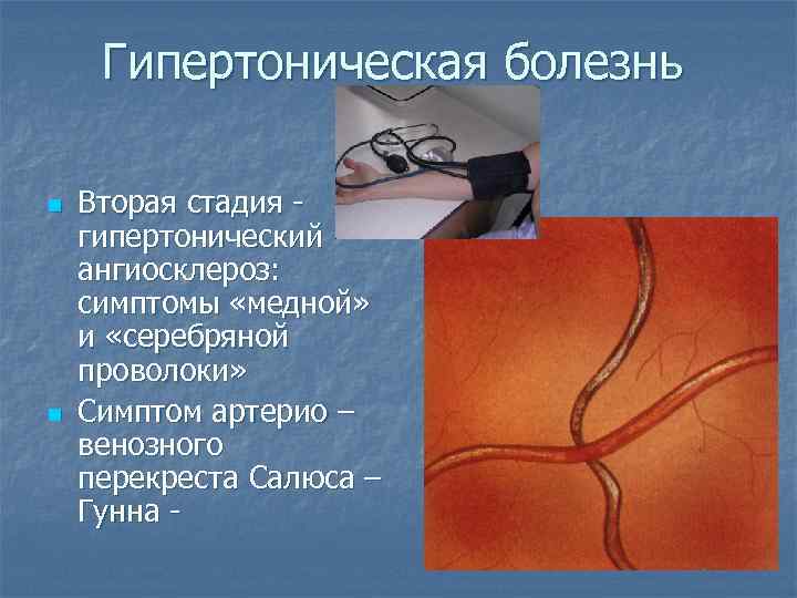 Гипертоническая болезнь n n Вторая стадия гипертонический ангиосклероз: симптомы «медной» и «серебряной проволоки» Симптом