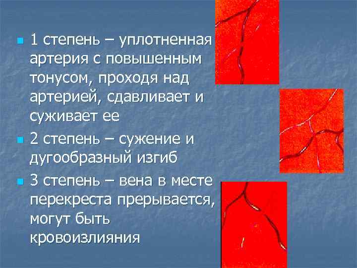 n n n 1 степень – уплотненная артерия с повышенным тонусом, проходя над артерией,
