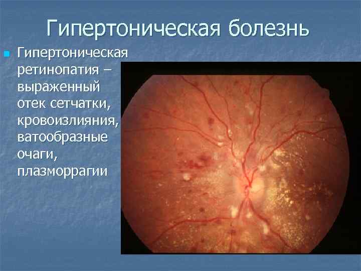 Гипертоническая болезнь n Гипертоническая ретинопатия – выраженный отек сетчатки, кровоизлияния, ватообразные очаги, плазморрагии 