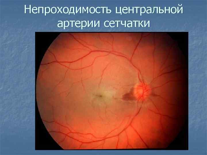 Непроходимость центральной артерии сетчатки 
